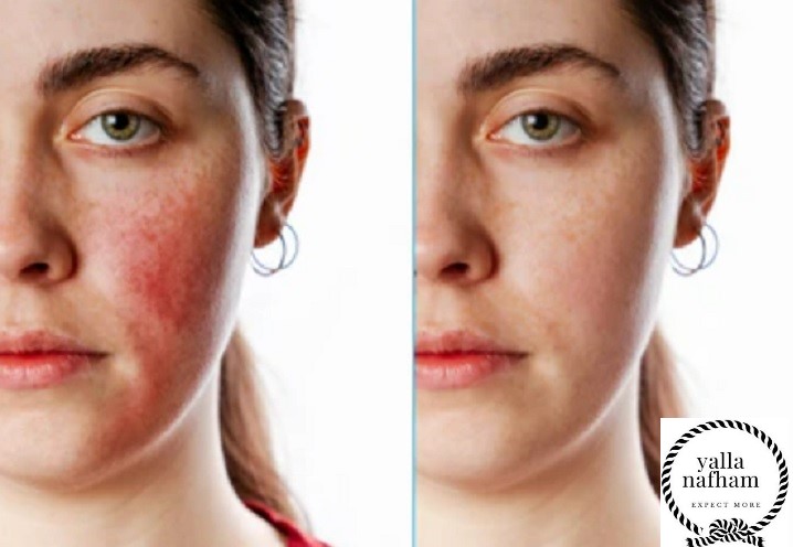 علاج بشرة الوجه الحساسة