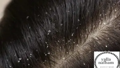 طرق التخلص من قشرة الشعر