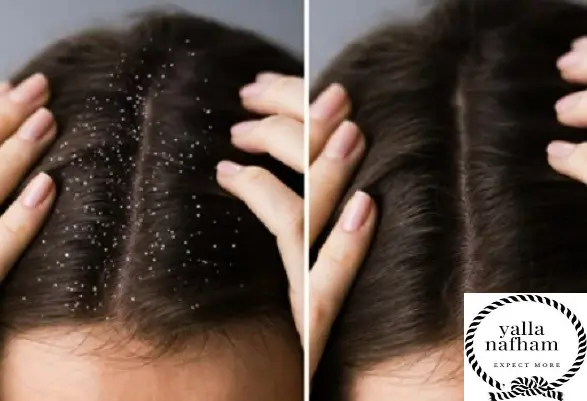 علاج قشره الشعر