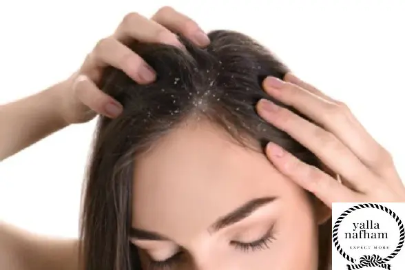 طرق التخلص من قشرة الشعر