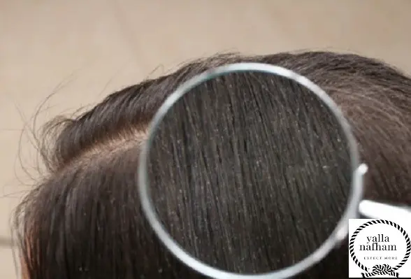 وصفات قشرة الشعر