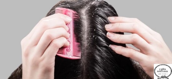 اسباب قشرة الشعر عند النساء